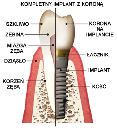 implanty2